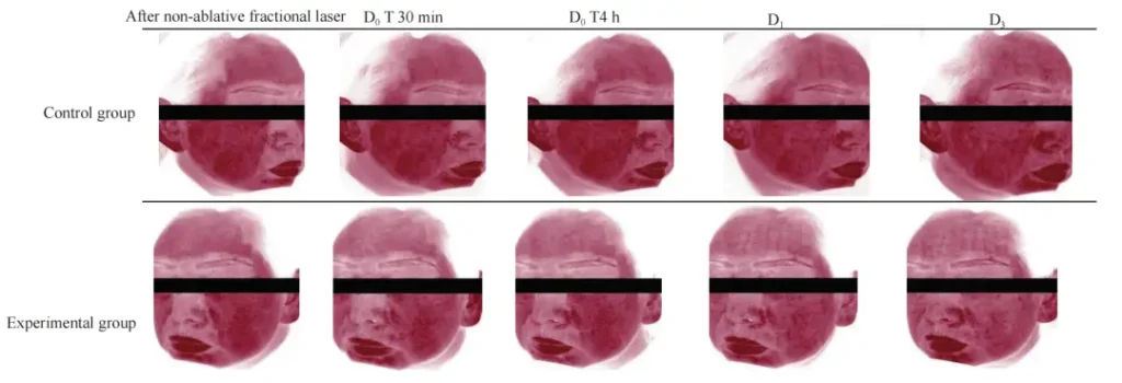 Post-Laser Facial Redness Recovery PDRN Essence vs Vehicle Through Day 3